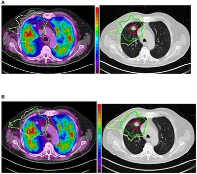 Radiation Therapy Planning of Thoracic Tumors: A Review of Challenges Associated With Lung Toxicities and Potential Perspectives of Gallium-68 Lung PET/CT Imaging